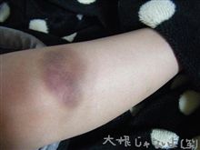 傷物になりました(&#180;(･)｀)お嫁ﾆｲｹﾅｲ･･･｡