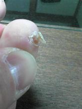 左足小指の