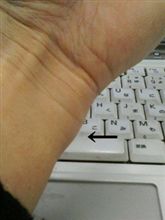 ガングリオン