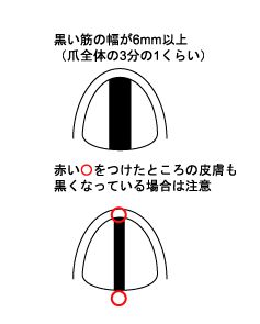 本当は怖い爪の筋 漆黒の落とし穴 本当は怖い家庭の医学より ぎりちょ Rのブログ Take It Easy みんカラ