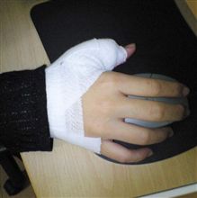 嫁さん、１２針のケガorz