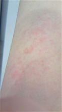 刺された・・・