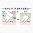 親知らずを抜いたんだけどねぇｗ