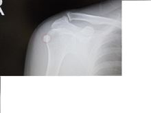 ★石灰沈着性肩関節周囲炎の痛み～上腕骨にサク◇ドロップみたいな物体が・・・！★