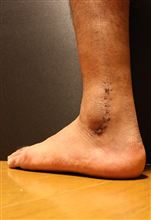 傷に弱い方は↓拡大しないで、その②