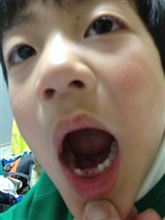 次男歯が抜けた（2つ目）