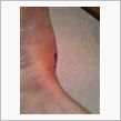 Hurted feet.