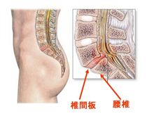 ヘルニアかなと思ったら ヘルニアかなと思ったら