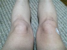 膝の痛み腫れその後・・・