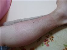 手も足もヒリヒリ