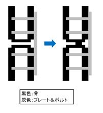 骨がつながり始めてます