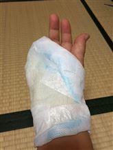 責任取り、小指、詰めました。。。