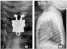 異物を飲み込んだ乳児をレントゲンしたら「スポンジボブ」が映ったと話題に