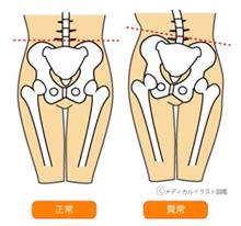 車の骨板矯正 アライメント 車の骨板矯正 アライメント