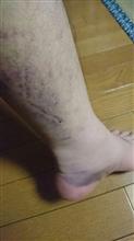 受傷５日目