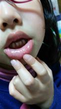 手足口病!? 手足口病!?