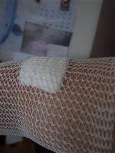 やけど治療