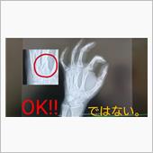骨折から5週間