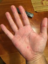 先が見えない大人の手足口病(TT) 先が見えない大人の手足口病(TT)