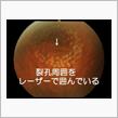 半年ぶりに眼科医へ