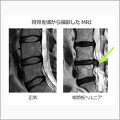 椎間板ヘルニヤ術後