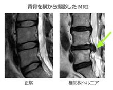 椎間板ヘルニヤ術後