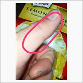手の親指側面の感覚が麻痺してる