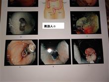 大腸ポリープ、ＥＭＲ、網膜検査
