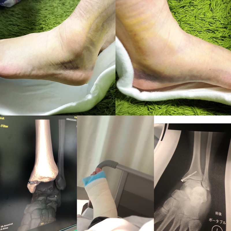 事後報告 骨折しました Kim Z のブログ ぼちぼちと みんカラ 事後報告 骨折しました Kim Z のブログ ぼちぼちと みんカラ