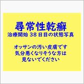 尋常性乾癬治療開始して38日 ...