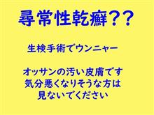 乾癬なる赤いブヅフツ。生検結果待ちの今日このごろ 乾癬なる赤いブヅフツ。生検結果待ちの今日このごろ
