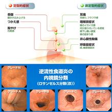 逆流性食道炎