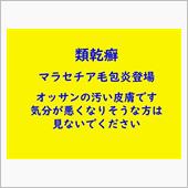 類乾癬です。尋常性乾癬として ...