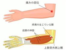 テニス肘＆腱鞘炎に…(&gt;_&lt;)