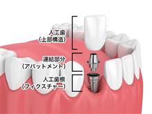 親知らずの暴走始まる 親知らずの暴走始まる