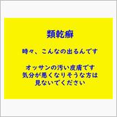 久しぶりに大きめの発疹きたー ...
