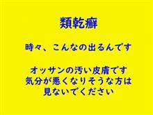 久しぶりに大きめの発疹きたーっ (類乾癬ネタ)