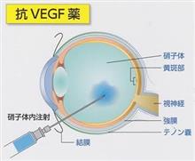 加齢黄斑変性症