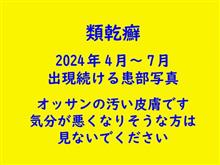 久しぶりに類乾癬肌を出してみる 久しぶりに類乾癬肌を出してみる
