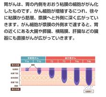 ドクター５年経過観察終了です、胃がん再発なしで完治