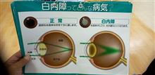 後発白内障で レーザー治療